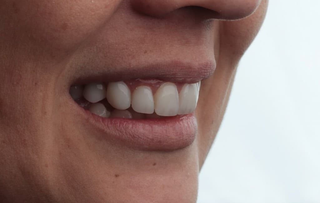 Sorriso com resultado estético de clareamento e alinhamento em Osasco