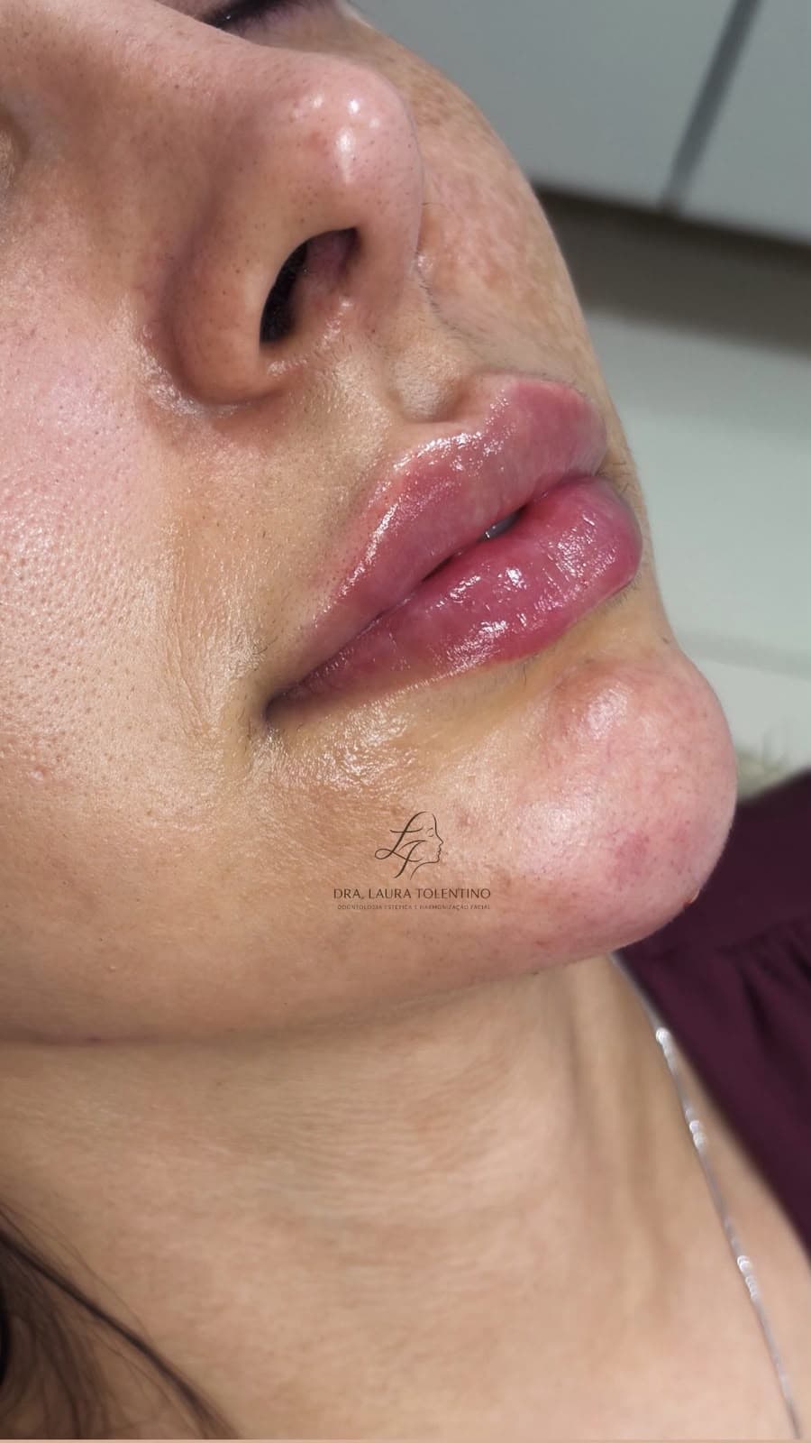 Resultado de harmonização facial — Dra. Laura Tolentino em Osasco